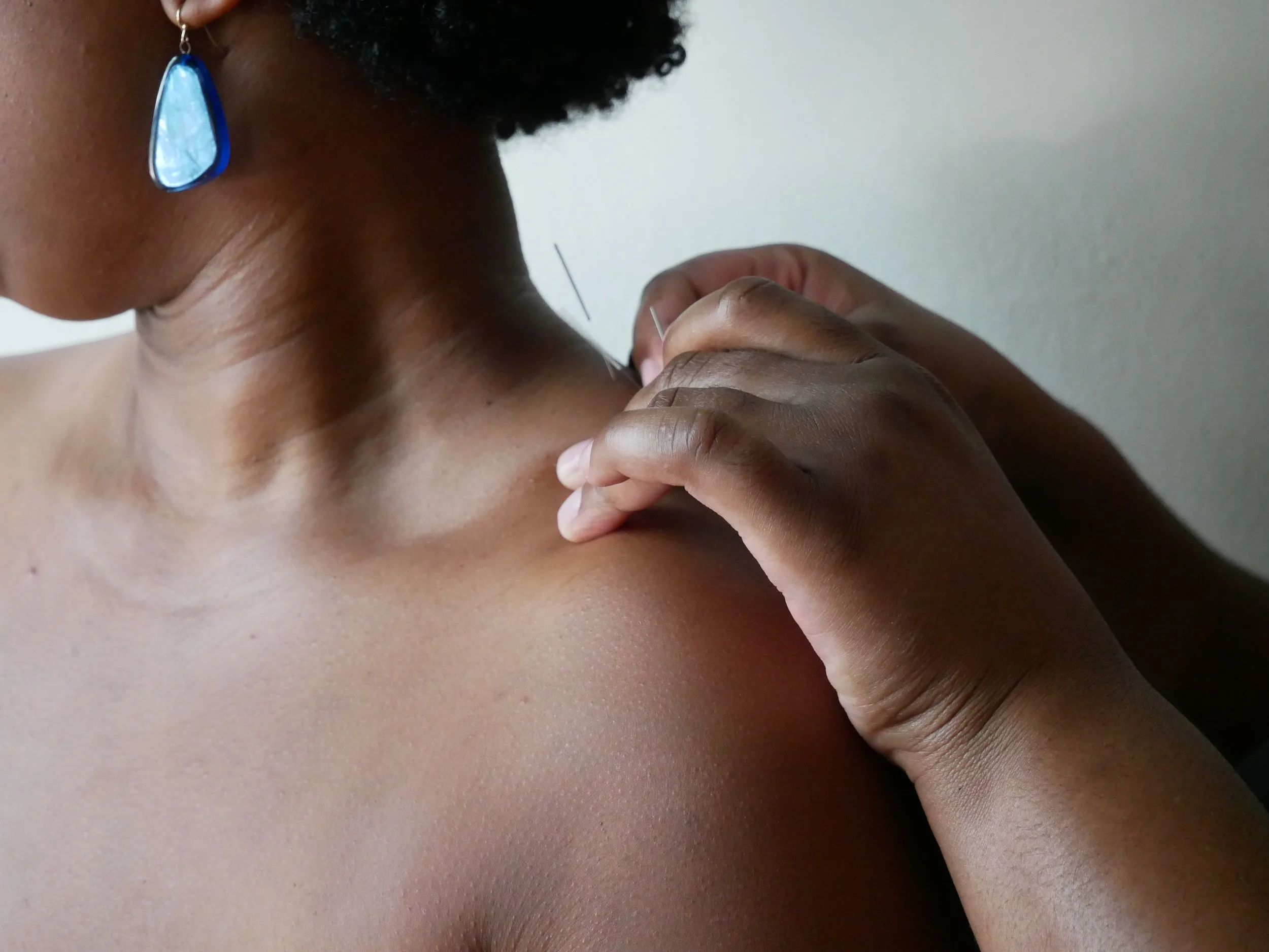 Acupuncture for neck pain in NYC: person getting acupuncture for neck pain