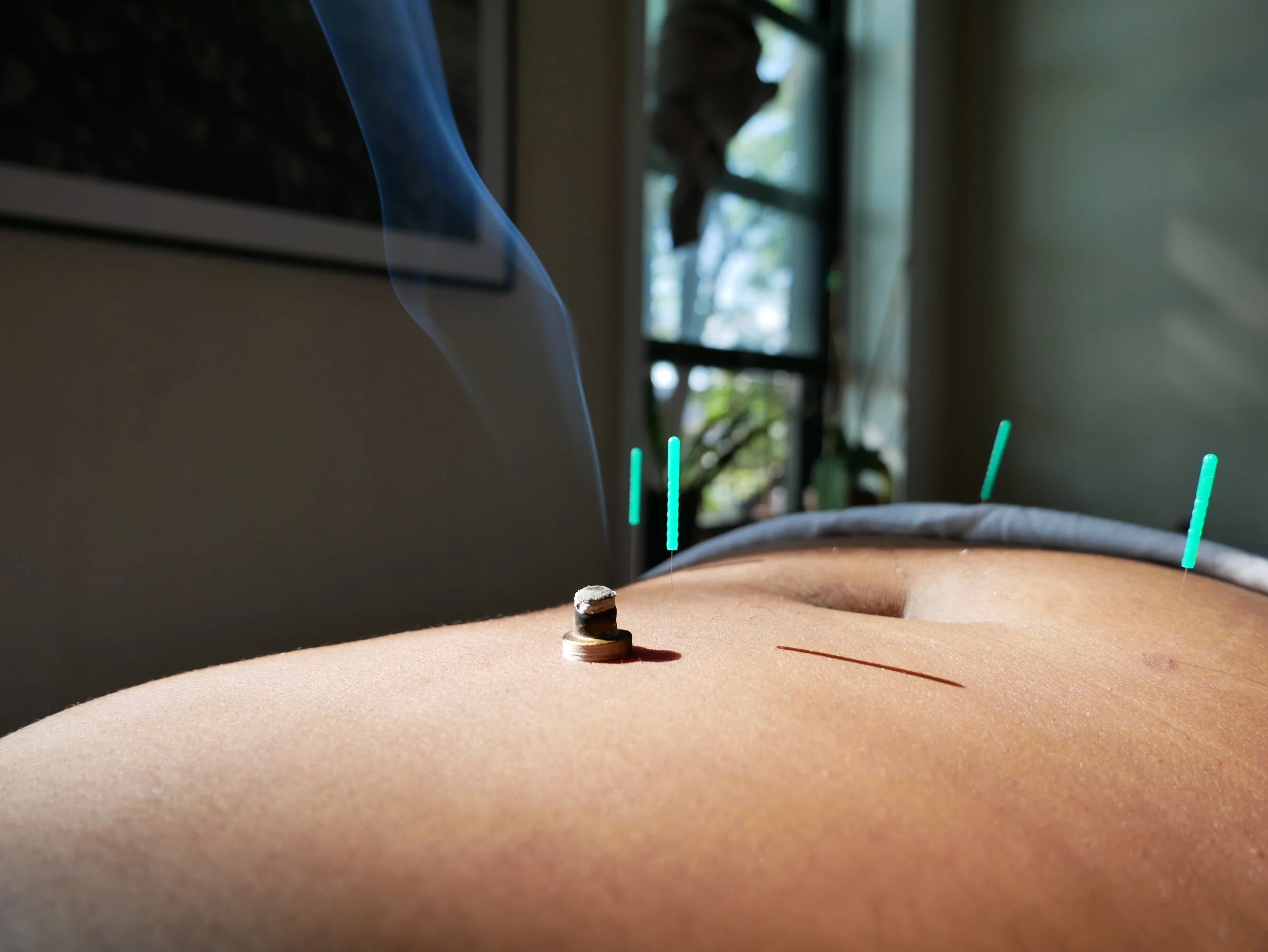 Acupuncture needles inserted into a person's belly with moxa burning near the needles. Acupuncture for digestive issues, IBS, GERD, Endometriosis, PCOS, infertility, pelvic pain dysfunction in NYC. 