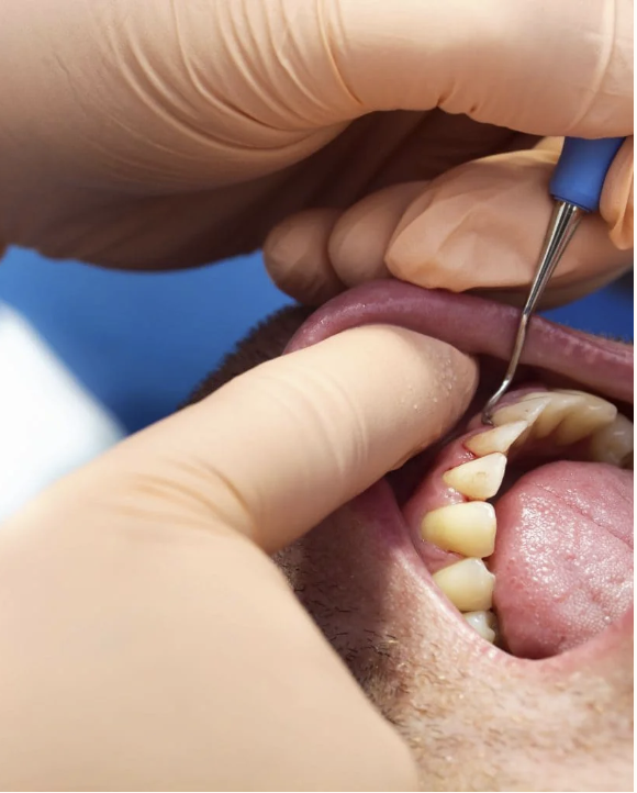 Close-up of a dental cleaning procedure with a person receiving treatment; dental tools are used near the person's open mouth, revealing teeth and gums.