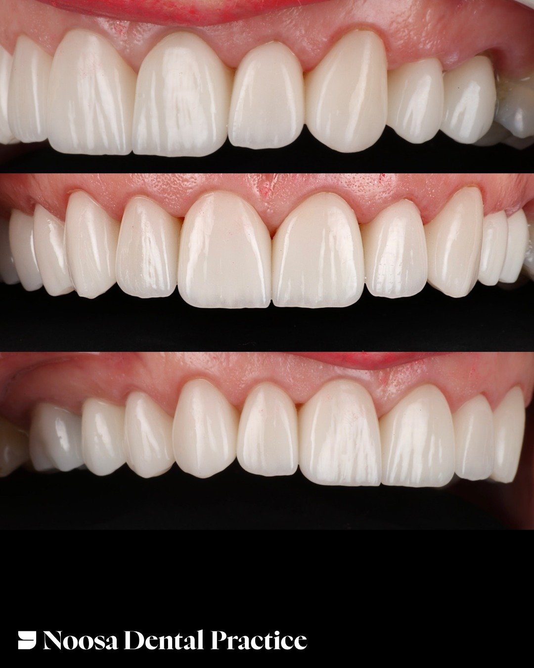 A smile tailored to you.

Our porcelain veneers are carefully crafted to improve shape, symmetry, and colour while maintaining a natural appearance.

#dental #dentistry #veneers

All treatments shown are performed by Dr O Chul (Hector) Shin DEN000199