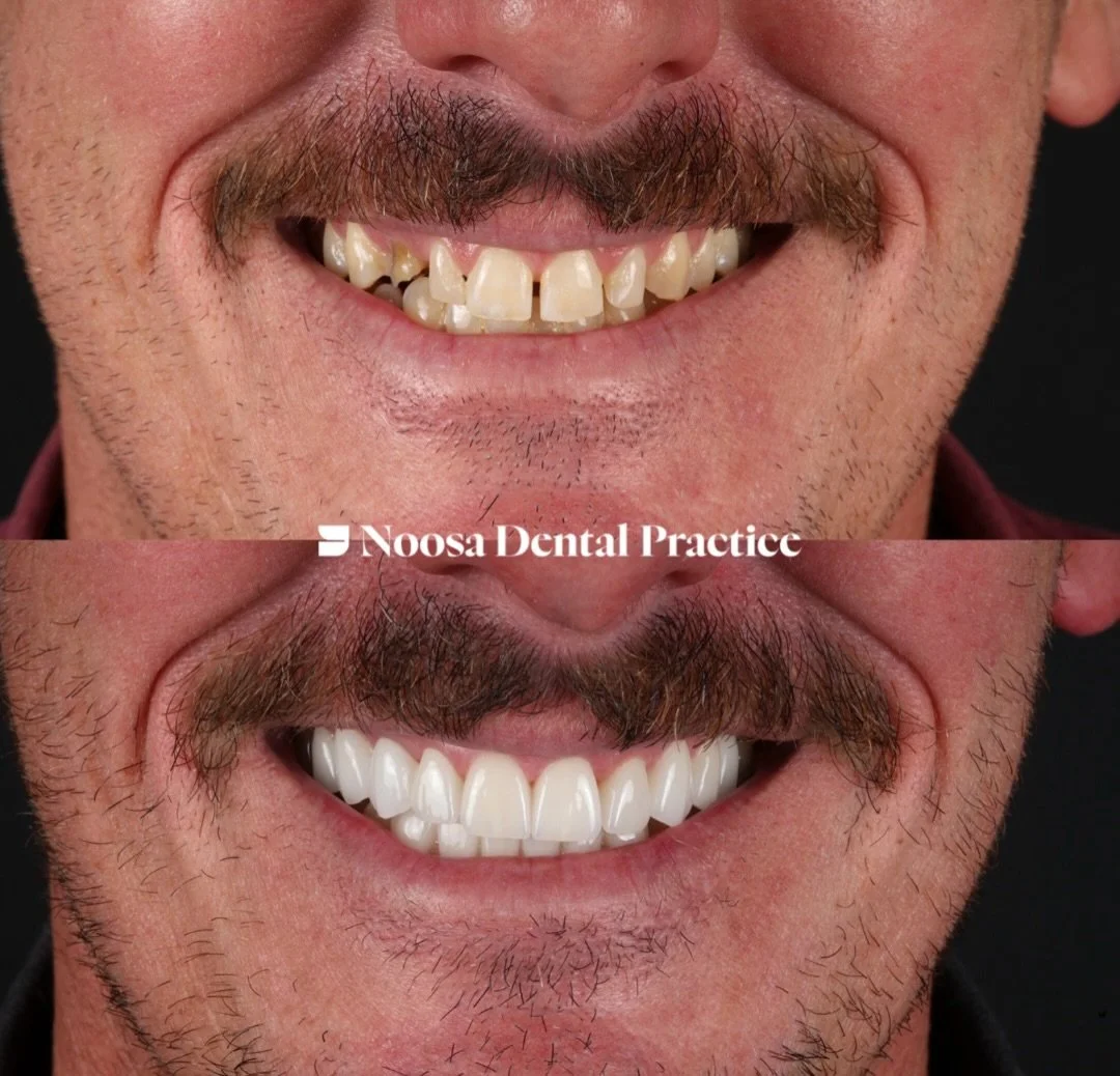 Comprehensive smile rehabilitation.

A combination of dental implants, crowns and veneers to restore function, refine proportions and create a natural, harmonious result.

Precision-led dentistry. Individualised treatment. Exceptional outcomes. 🦷

#