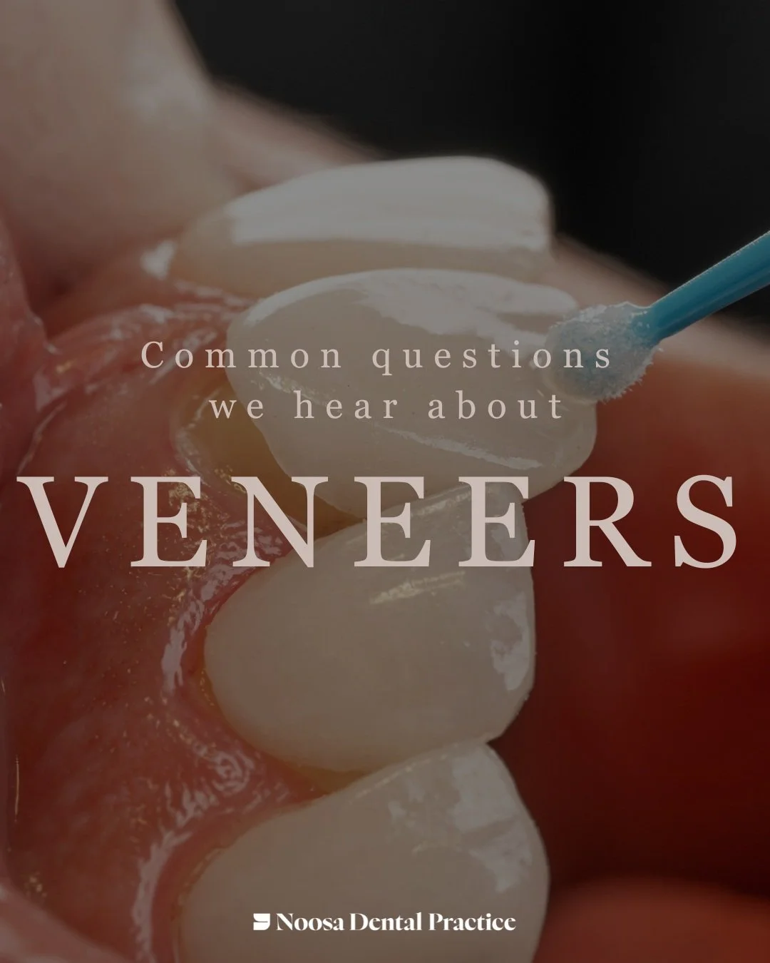 Thinking about veneers? Book a consultation to find out whether they&rsquo;re right for your smile. 💫

#DentalVeneers #VeneersFAQ #CosmeticDentistry #SmileMakeover #Veneers #DentalCare #SmileGoals #CosmeticDentist #HealthySmile