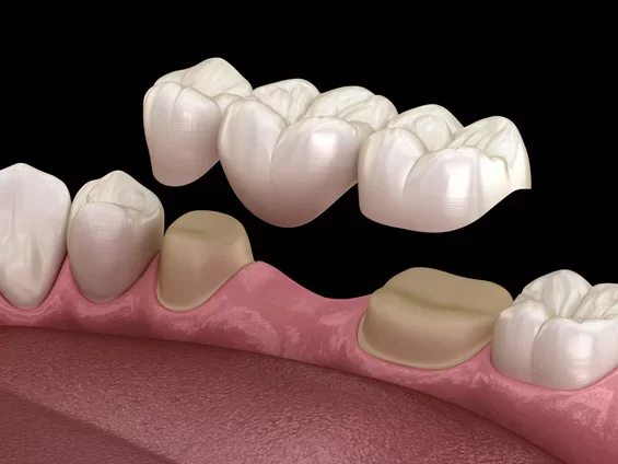 Dental model showing a tooth implant with a crown, flanked by natural teeth, on a dark surface with other dental models in the background.