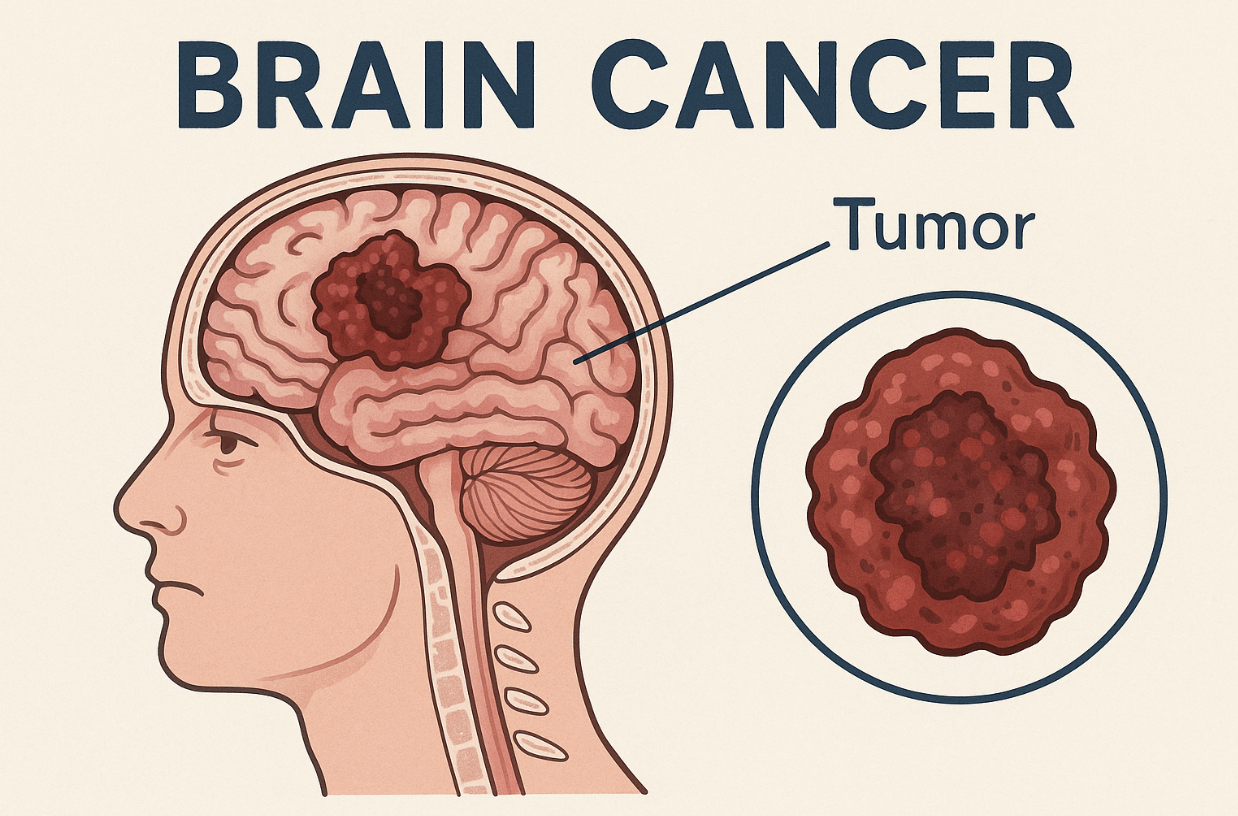 Illustration of a human head showing a cross-section of the brain with a tumor labeled 'Brain Cancer' and a close-up of the tumor.