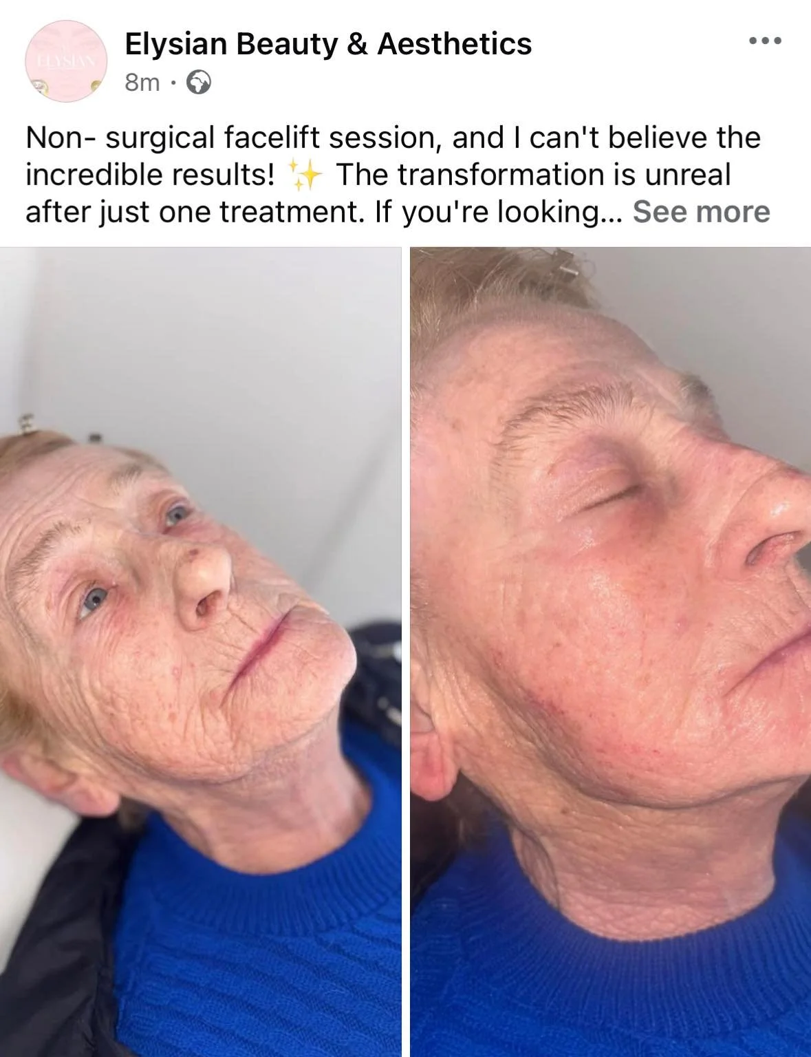 Side-by-side before and after photos of a woman showcasing non-surgical facelift results, with improved skin texture and reduced wrinkles.