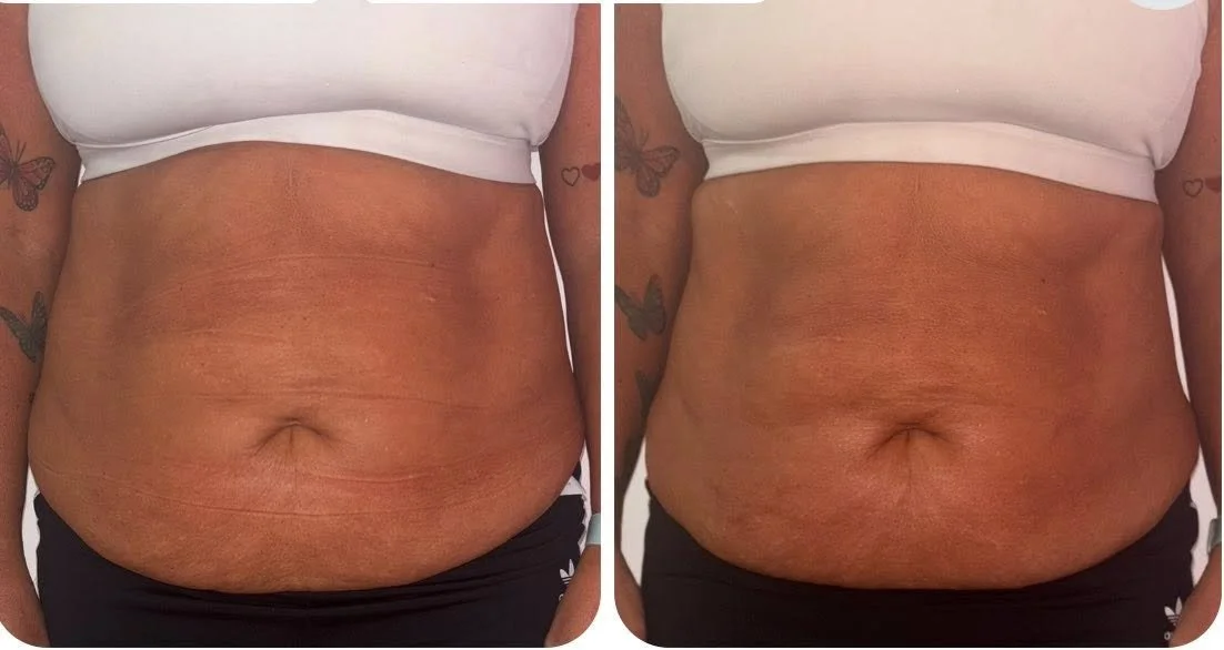 Before and after images of a person's midsection showing improved skin tone and texture, indicating a possible skin treatment or weight loss progress.