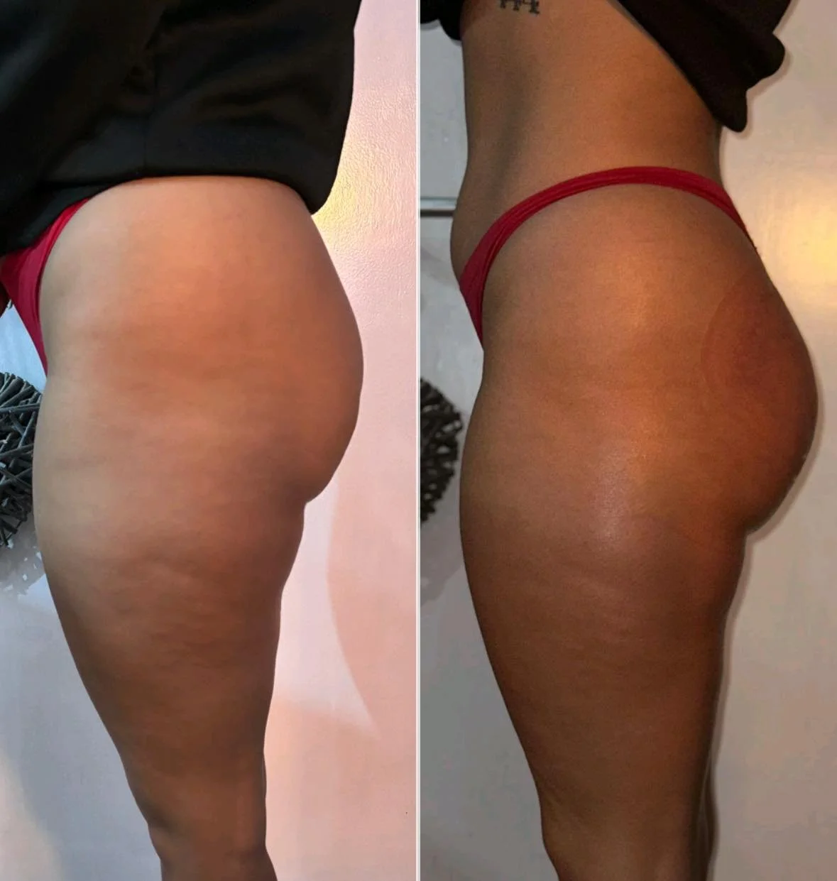 x1 Session Non-surgical XXL BBL