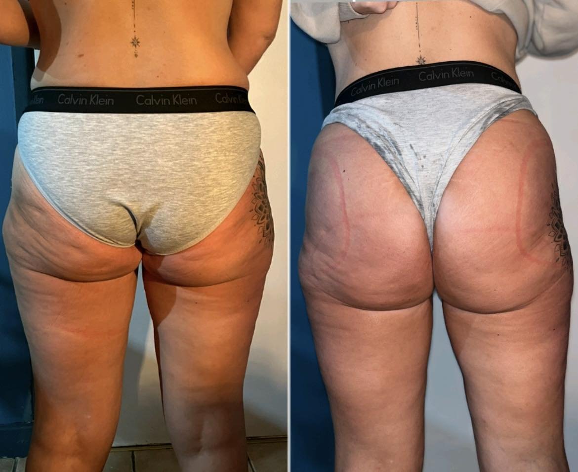 Side-by-side comparison of a woman's lower back and buttocks before and after a transformation, showing skin tightening and reduction in cellulite.