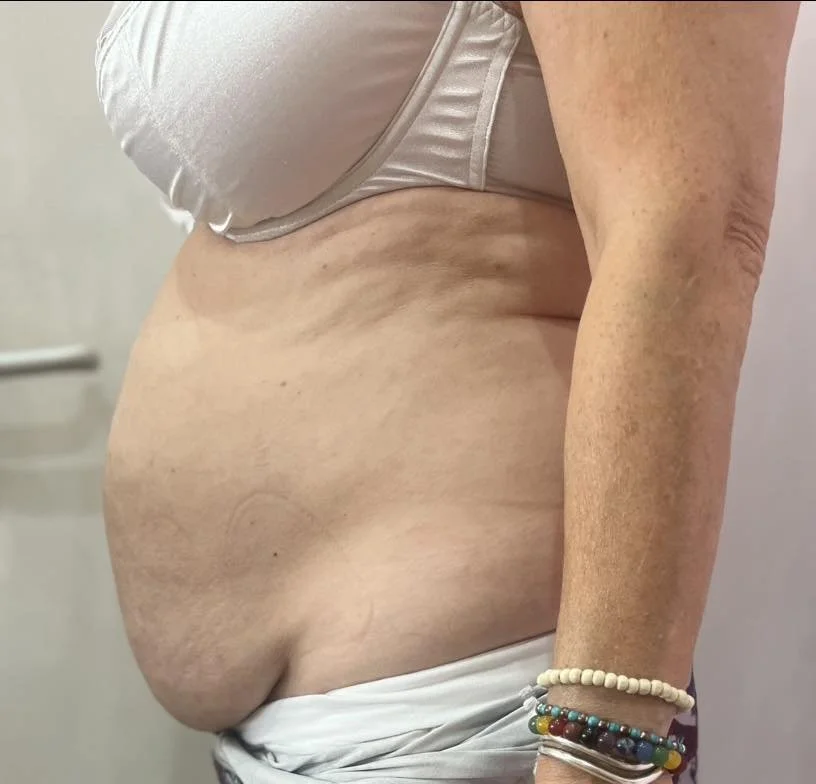 Close-up of an older woman's midsection showing loose skin and stretch marks, with bare arm and wrist jewelry.