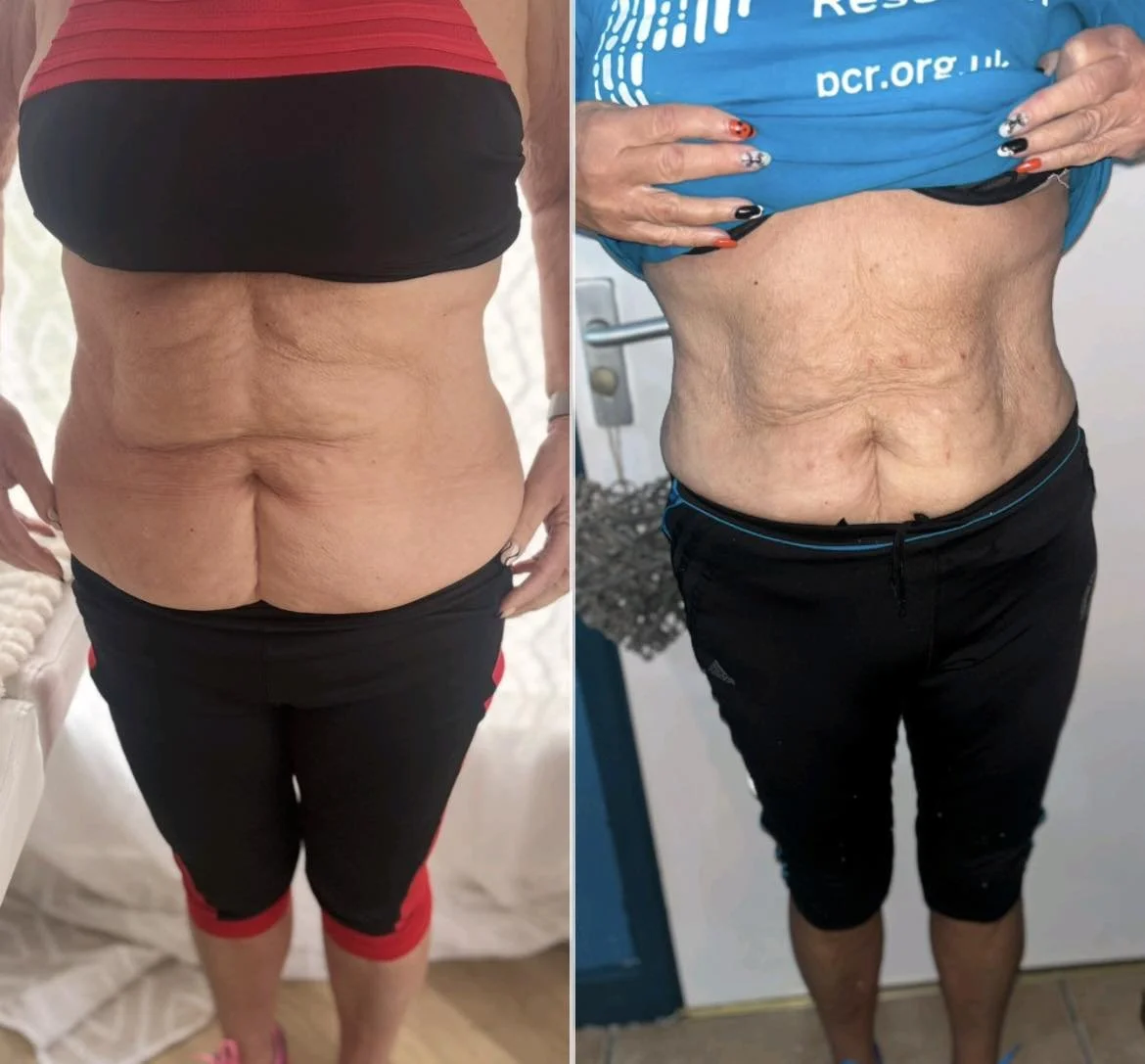 Side-by-side comparison of a woman's abdomen before and after weight loss, showing reduced abdominal fat and loose skin.