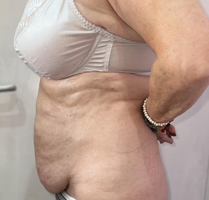 Close-up side view of a woman's torso, showing her stomach and part of her arm. She is wearing a beige bra and has bracelets on her wrist. The skin has noticeable wrinkles and age spots.