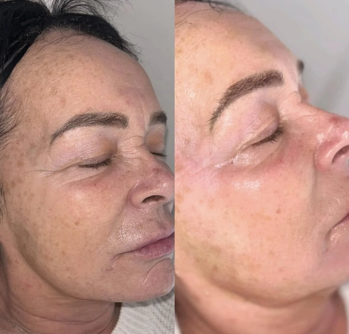 Side-by-side comparison of a woman's face before and after skincare or cosmetic treatment, showing improved skin texture and tone.