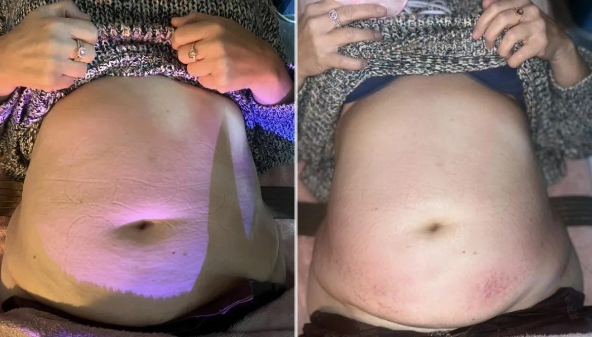Comparison of a person's bare stomach before and after a procedure or intervention, showing reduced skin looseness and redness.