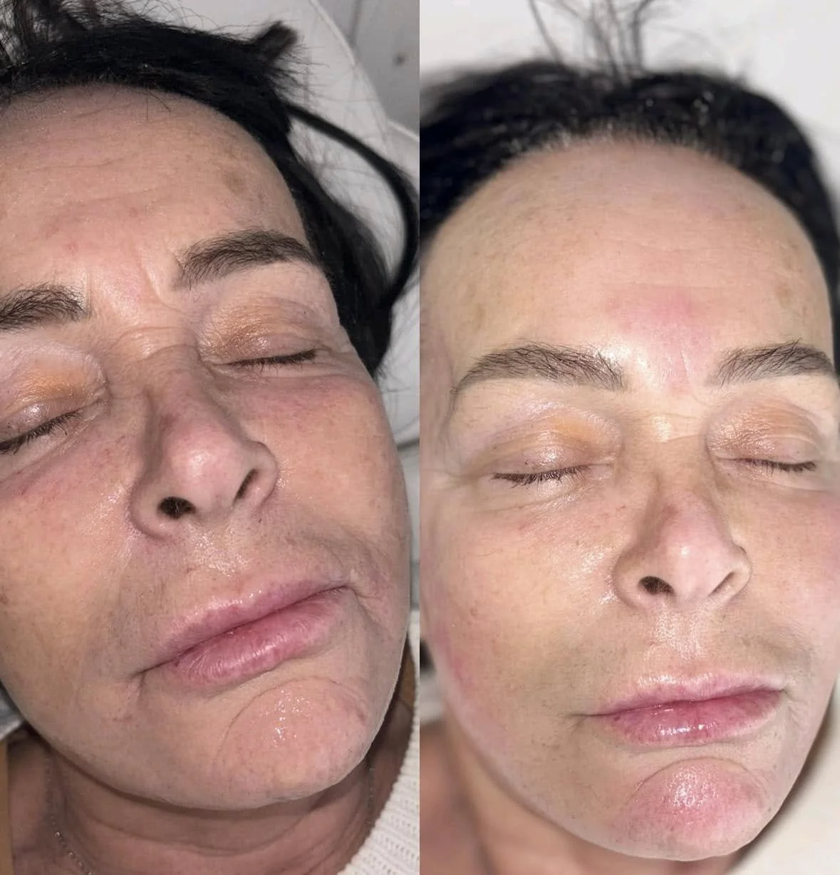 Close-up of a woman's face showing before and after skincare treatment, with visible improvements in skin texture, redness, and overall appearance.