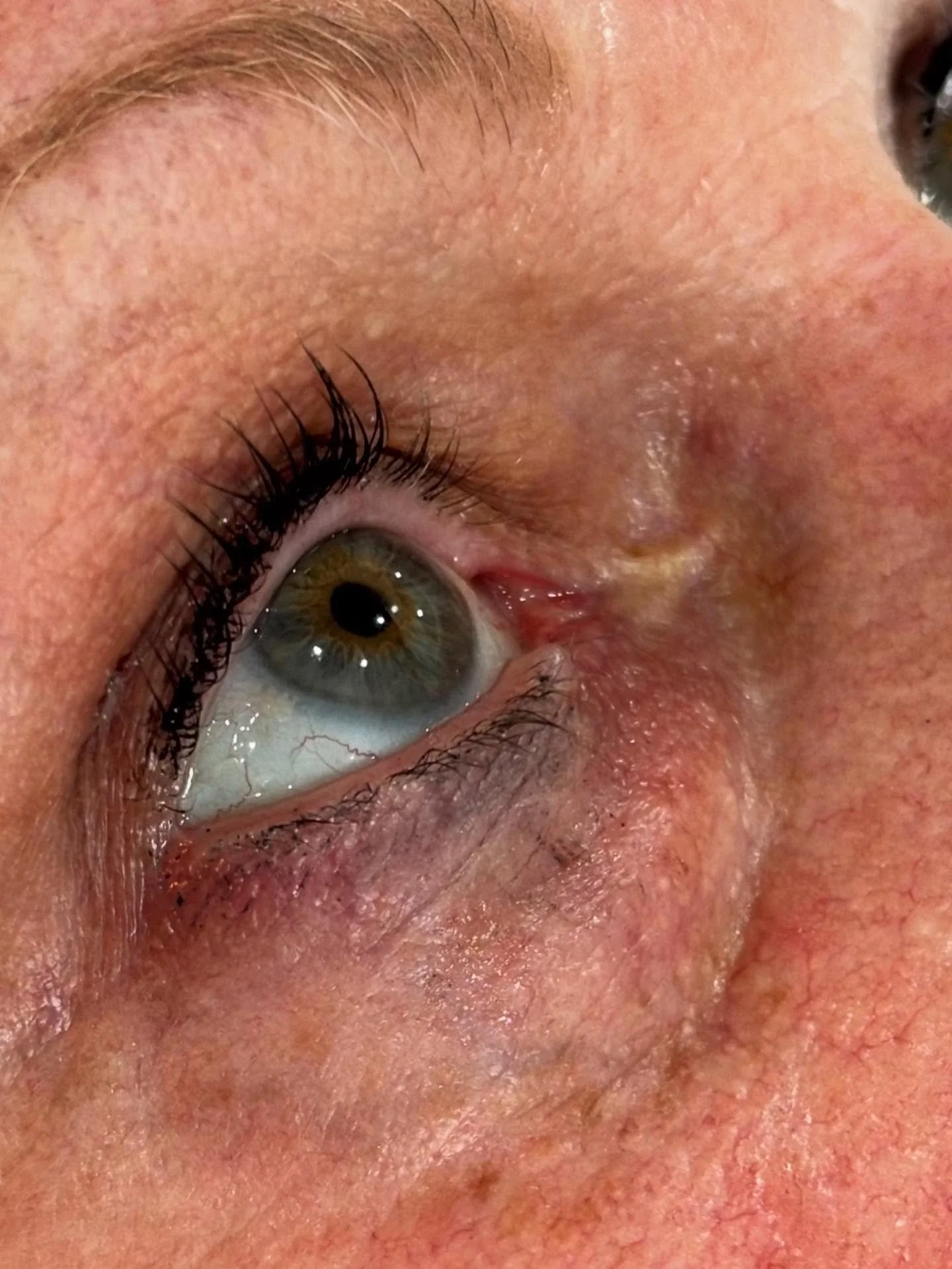 Close-up of a human eye with an eyelid and surrounding skin that appears irritated or inflamed.