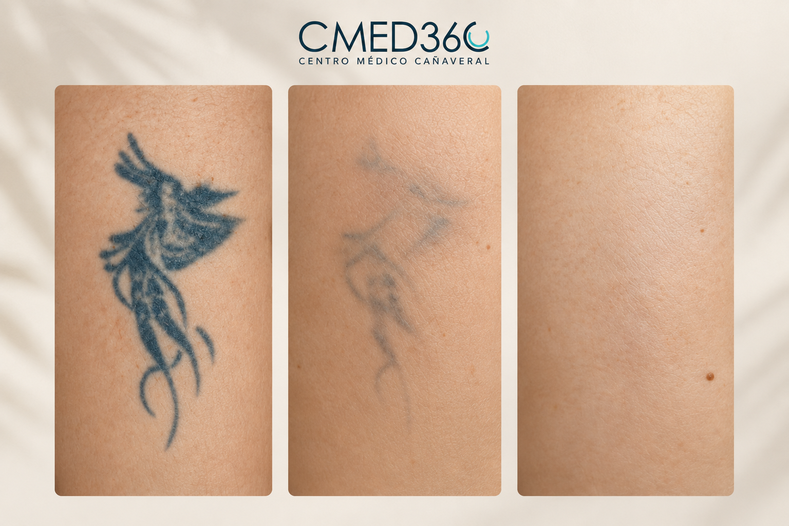 Proceso de eliminación de tatuajes: primera imagen con tatuaje visible, segunda imagen con tatuaje difuminado y tercera imagen sin tatuaje. Eliminació de tatuajes laser. Eliminación tatuajes Madrid.