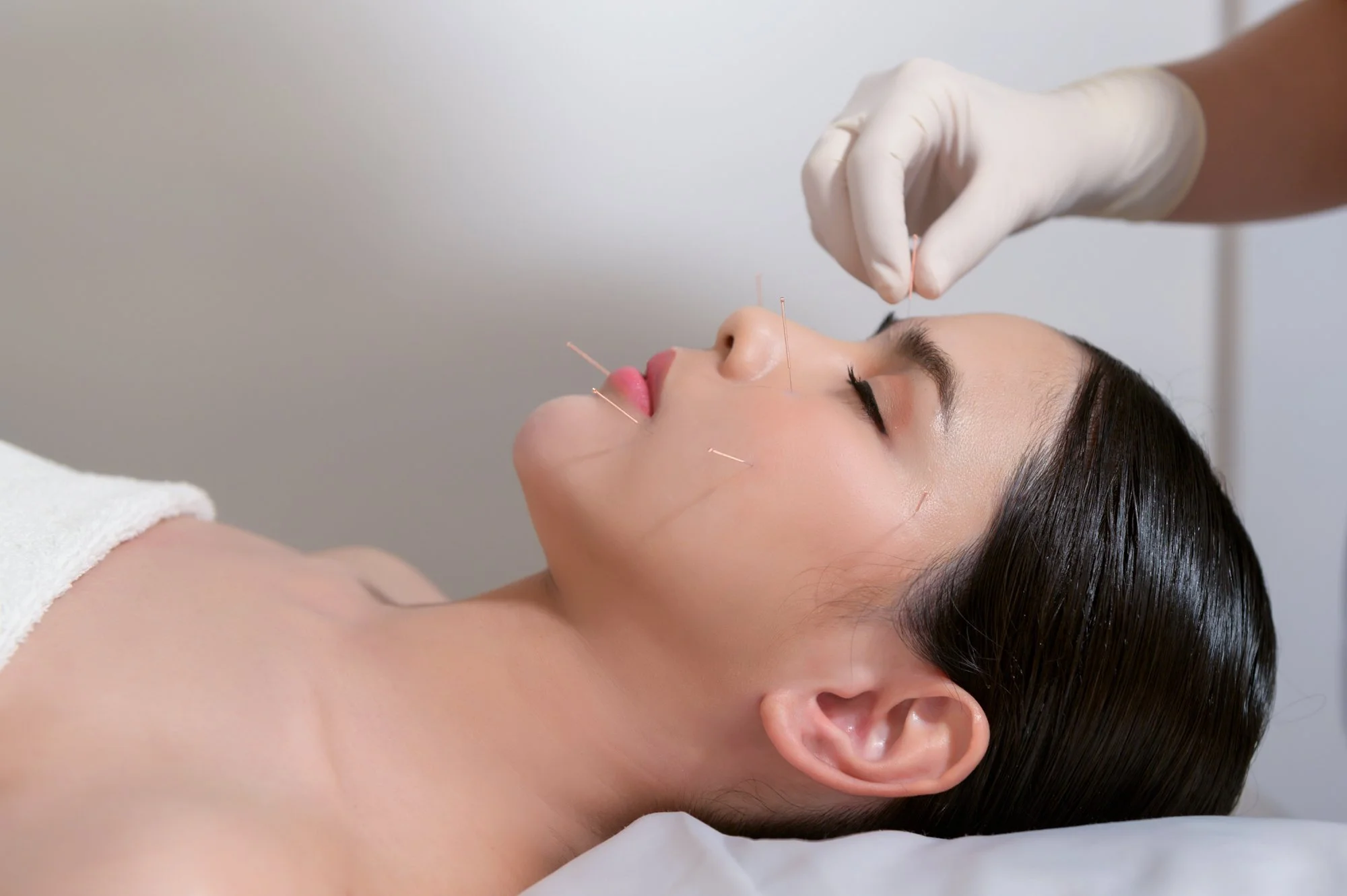 Facial acupuncture