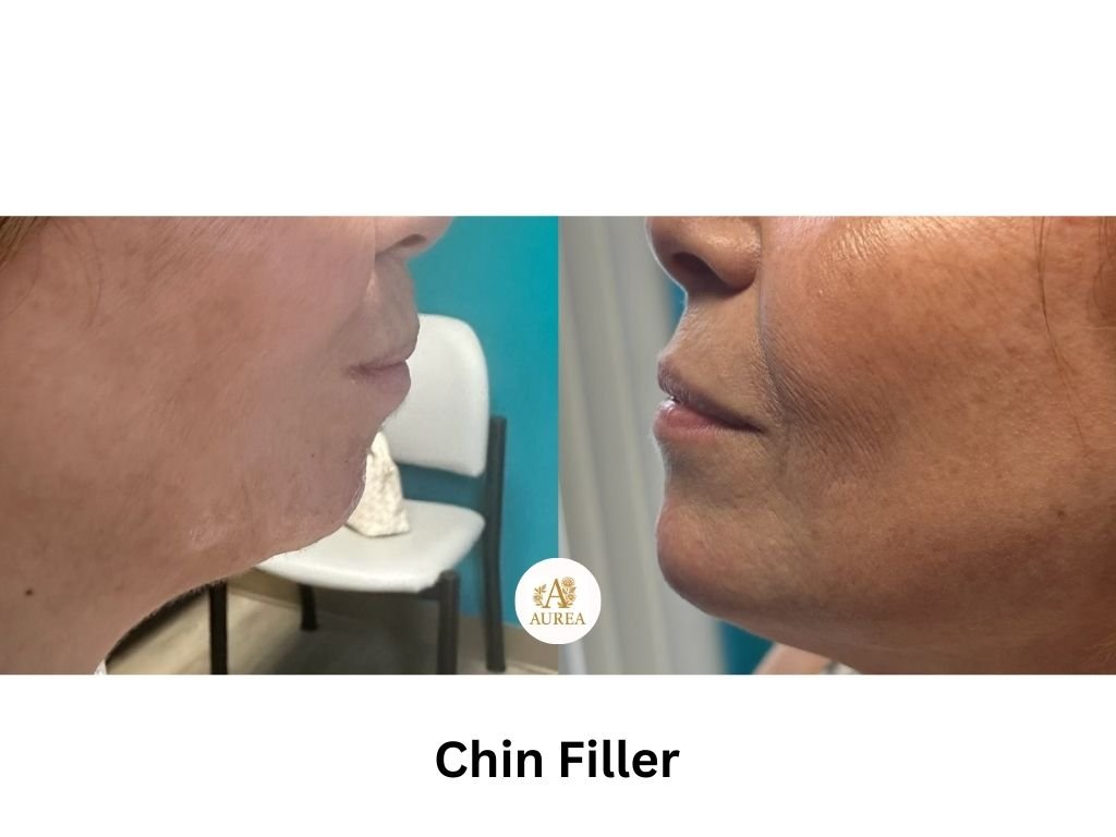 Chin Filler at Aurea Medical Aesthetics in New Berlin Wisconsin, proudly serving the greater Milwaukee area.