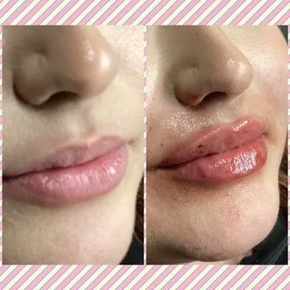Beautiful Lip enhancement at Aurea Medical Aesthetics in New Berlin Wisconsin.  Serving New Berlin, Muskego, and the Surrounding Communities.