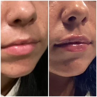 Lip Filler at Aurea Medical Aesthetics. Serving New Berlin, Muskego, and the Surrounding Communities.