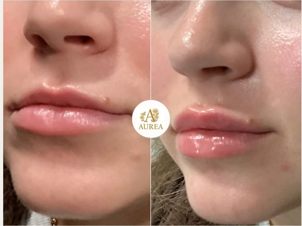 Lip Filler injection at Aurea Medical Aesthetics in New Berlin Wisconsin.  Serving New Berlin, Muskego, and the Surrounding Communities.  