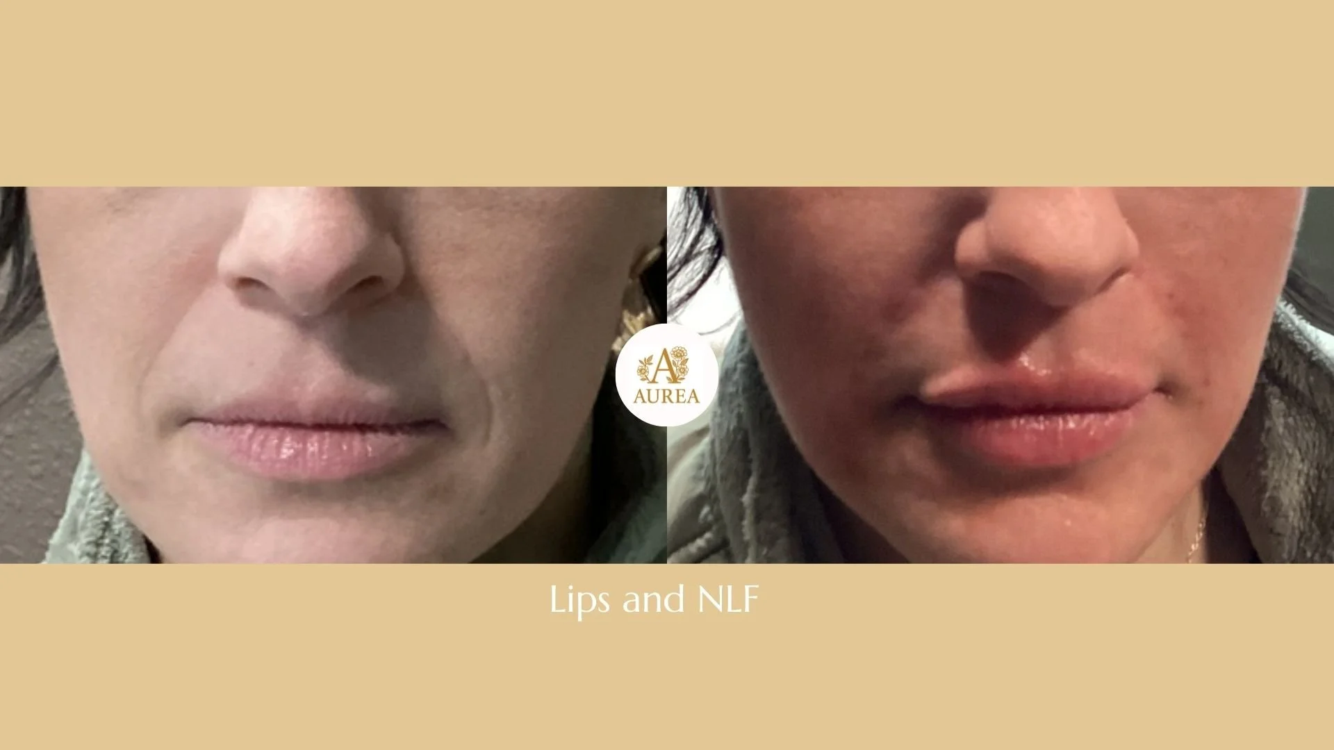 Nasal Labial Folds and Lip Filler at Aurea Medical Aesthetics in New Berlin.