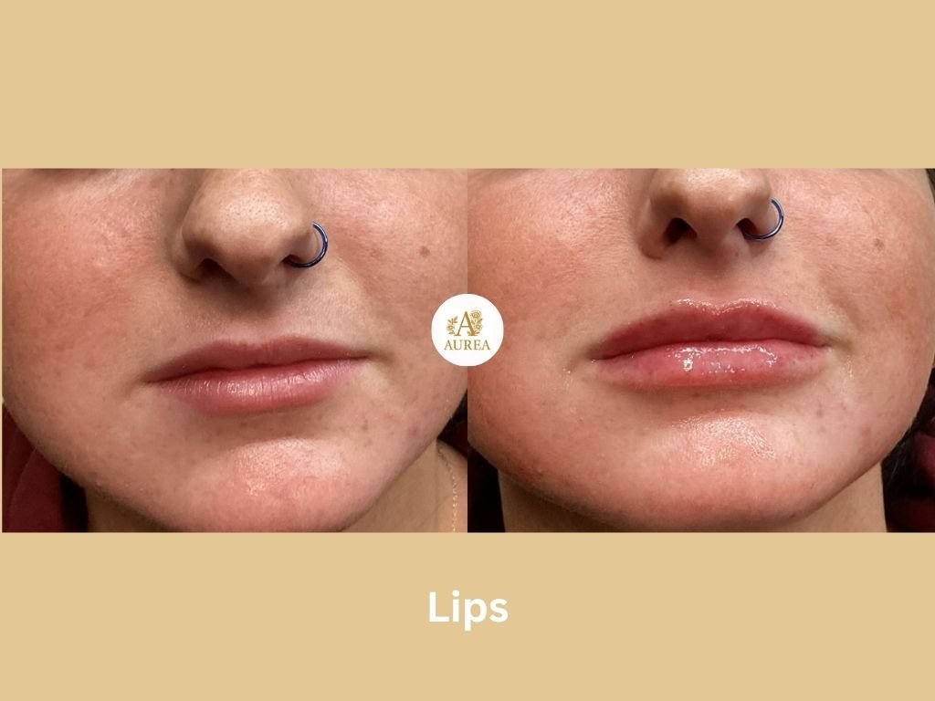 Before and After lip filler showing fuller lips at Aurea Medical Aesthetics in New Berlin.  