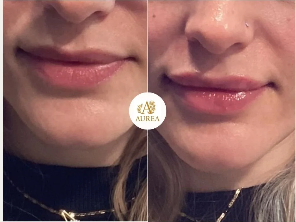 Lip Filler at Aurea Medical Aesthetics in New Berlin.  Proudly serving New Berlin, Muskego, Brookfield, and surrounding communities.