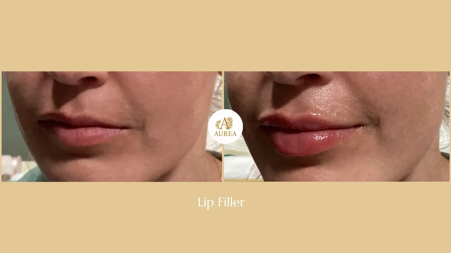 Lip Filler at Aurea Medical Aesthetics in New Berlin Wisconsin.