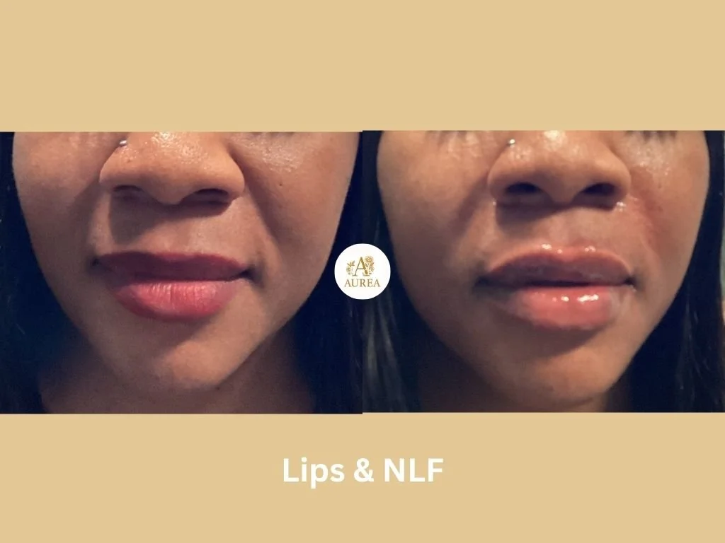 Lip Filler and nasolabial folds enhancement at Aurea Medical Aesthetics in New Berlin, and surrounding communities.