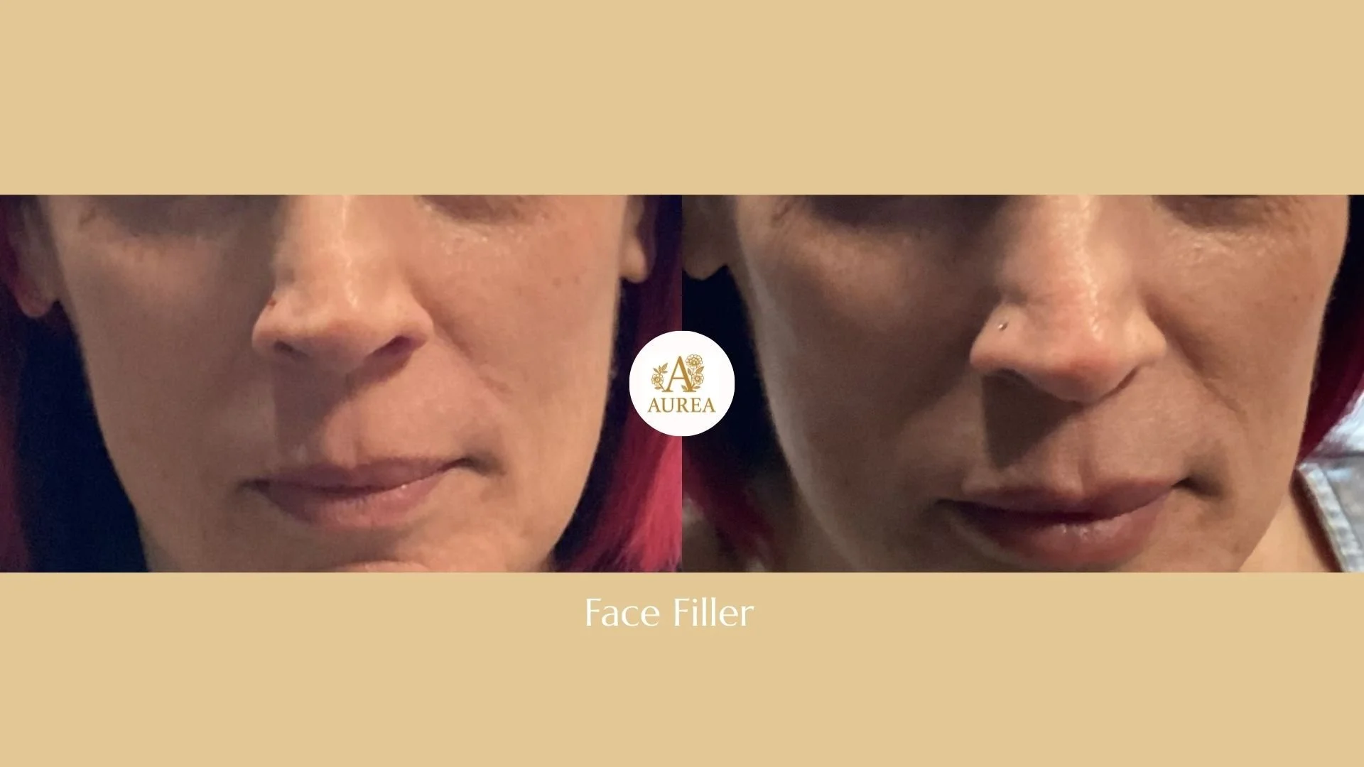 Subtle Cheek Filler treatment at Aurea Medical Aesthetics, serving New Berlin and Muskego.
