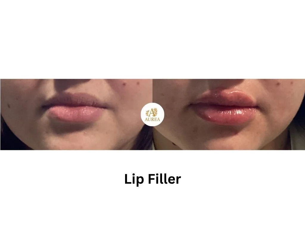 Lip Filler enhancement at Aurea Medical Aesthetics in New Berlin.