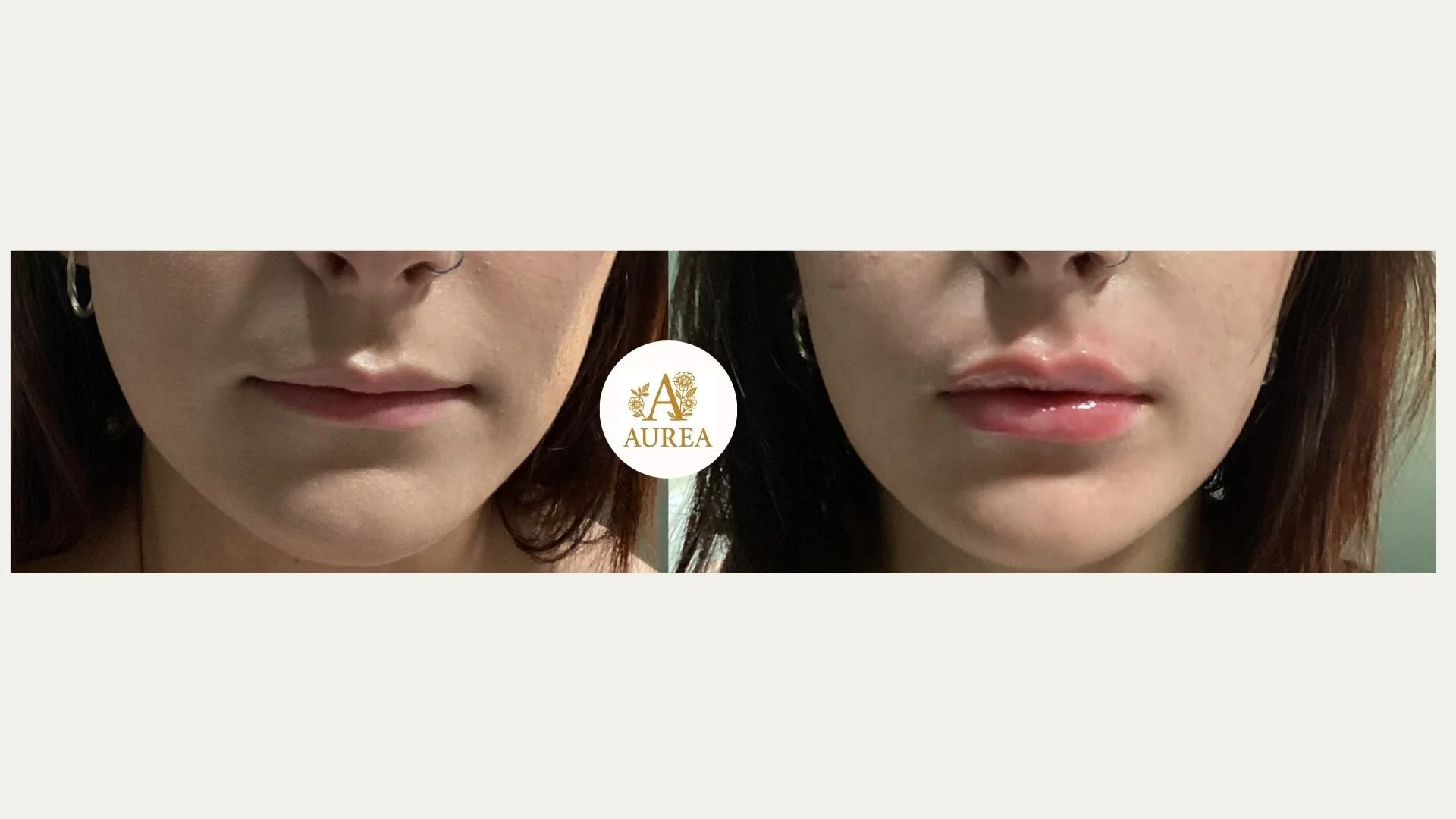 Lip Filler in New Berlin