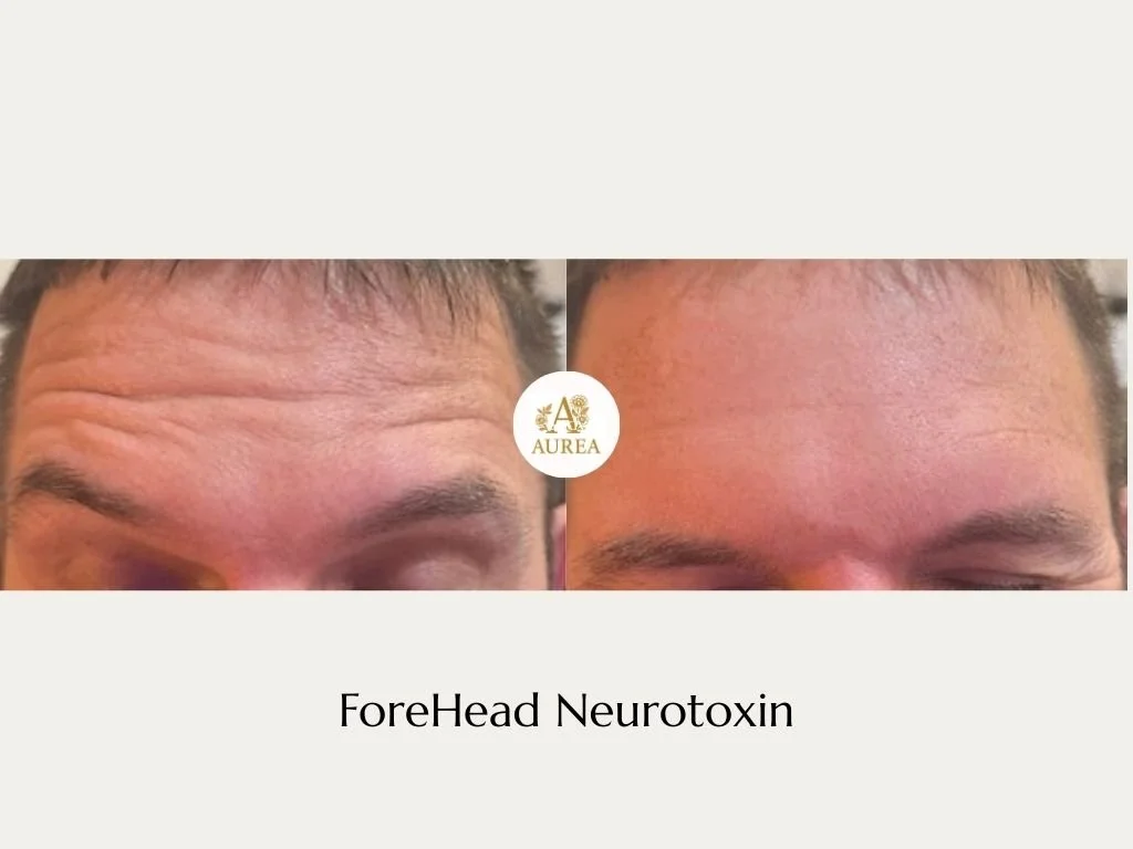 Neurotoxin wrinkle treatment at Aurea Medical Aesthetics in New Berlin Wisconsin. 