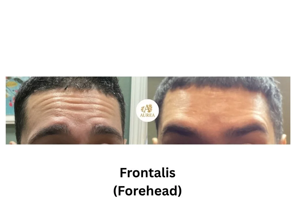 Botox in New Berlin