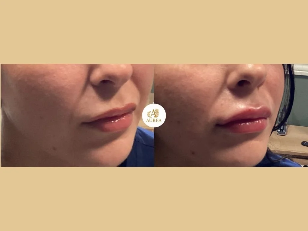 Lip Filler at Aurea Medical Aesthetics in New Berlin.  Proudly serving New Berlin, Muskego, Brookfield, and surrounding communities.