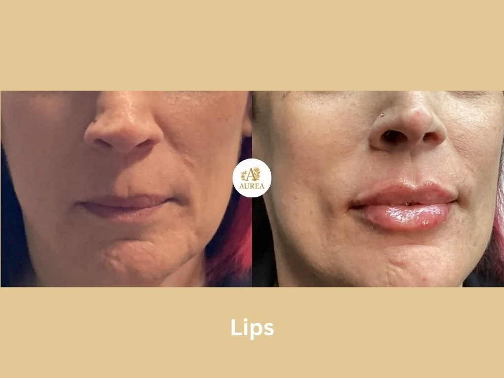 Amazing lip filler before and after photos showing fuller, improved contour, and pronounced cupid's bow enhancement at Aurea Medical Aesthetics in New Berlin.