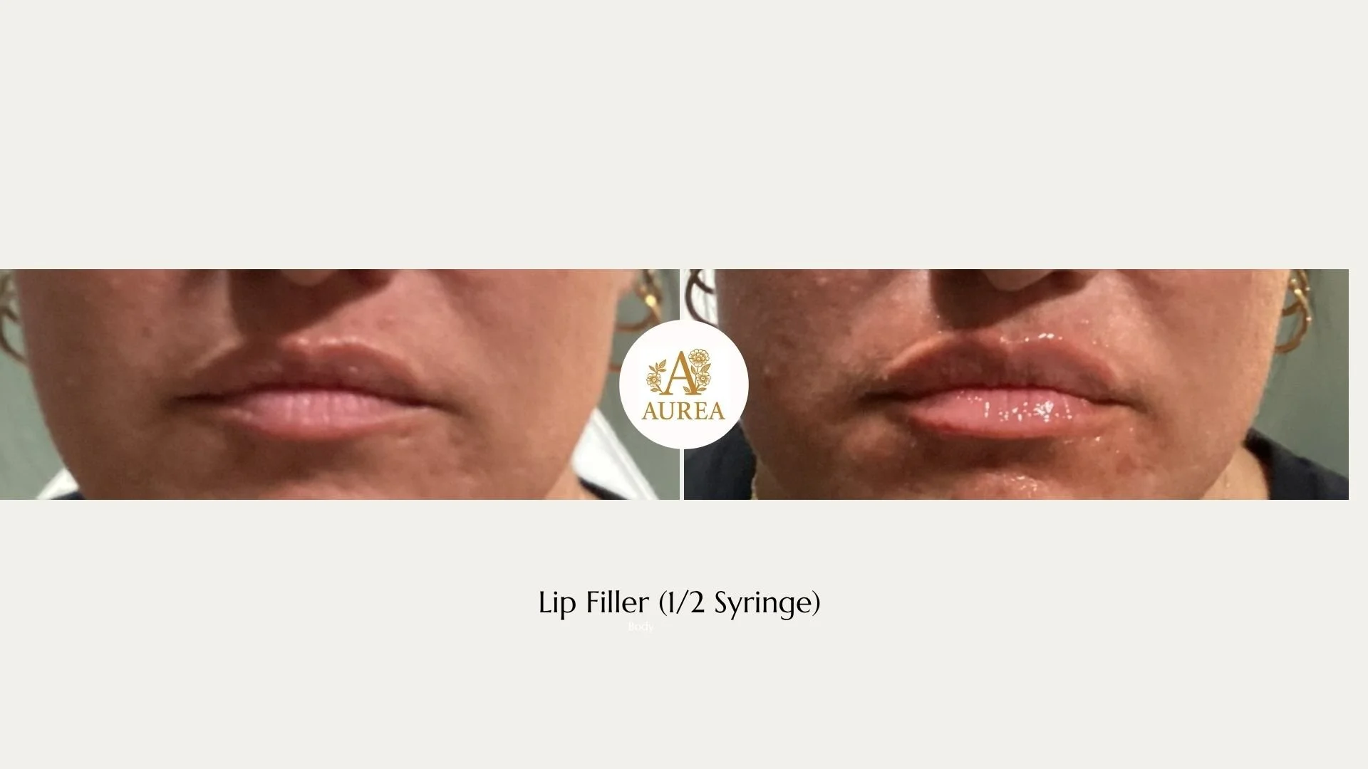 Before and After Lip Filler Photos at Aurea Medical Aesthetics