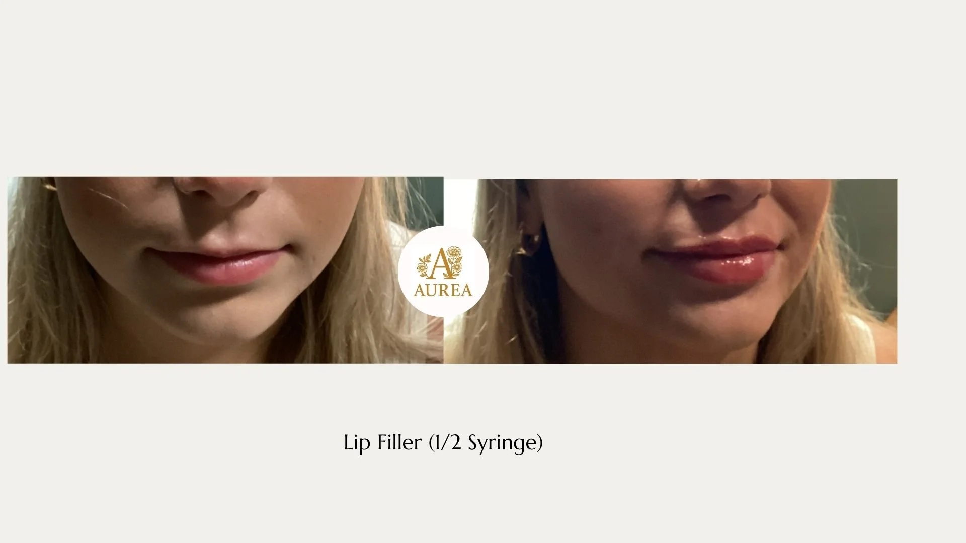 Before and After Photo of Lip Filler at Aurea Medical Aesthetics in New Berlin