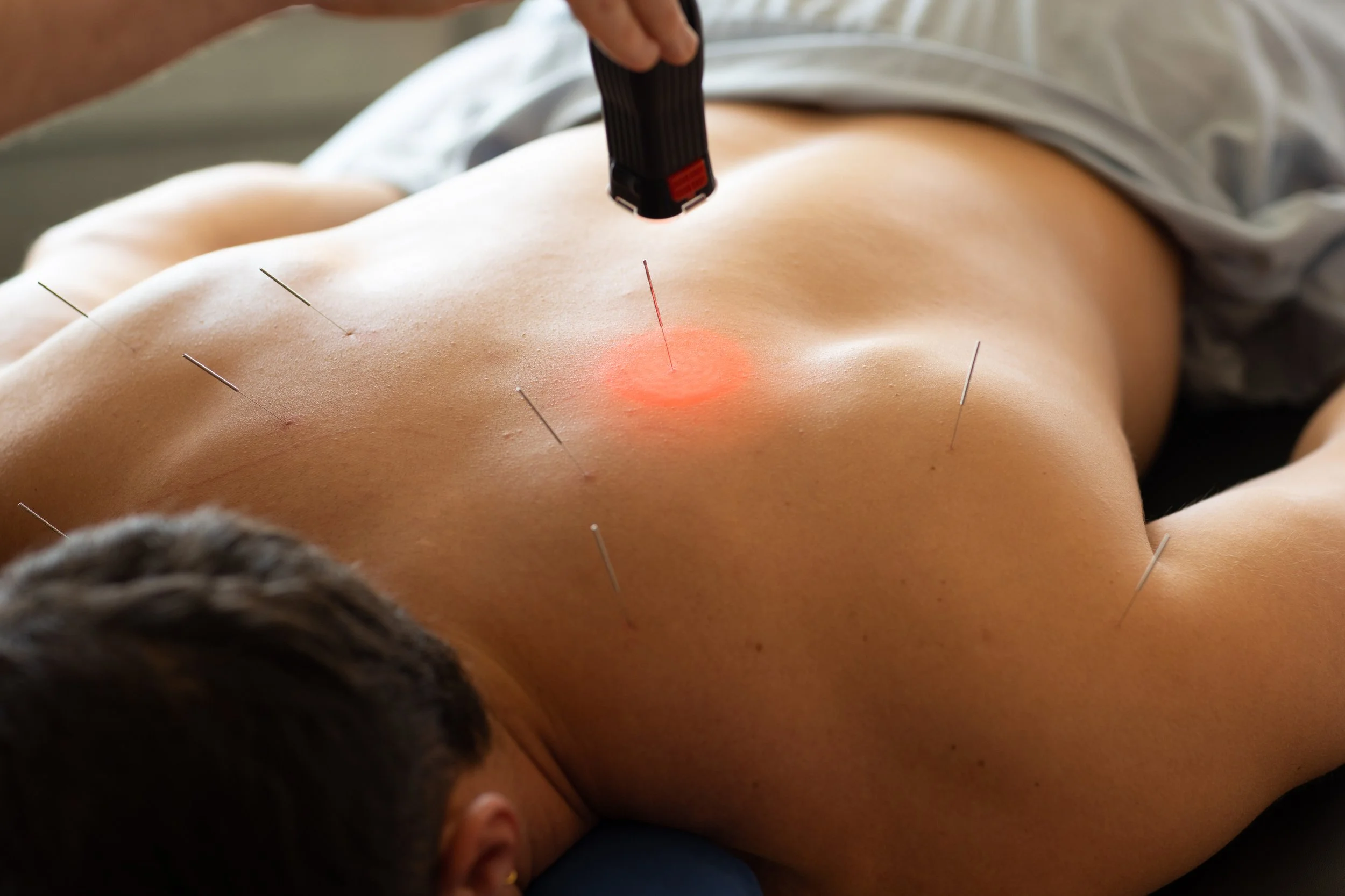 A person receiving acupuncture treatment with multiple acupuncture needles inserted into their back, and a red light laser aimed at their upper back.