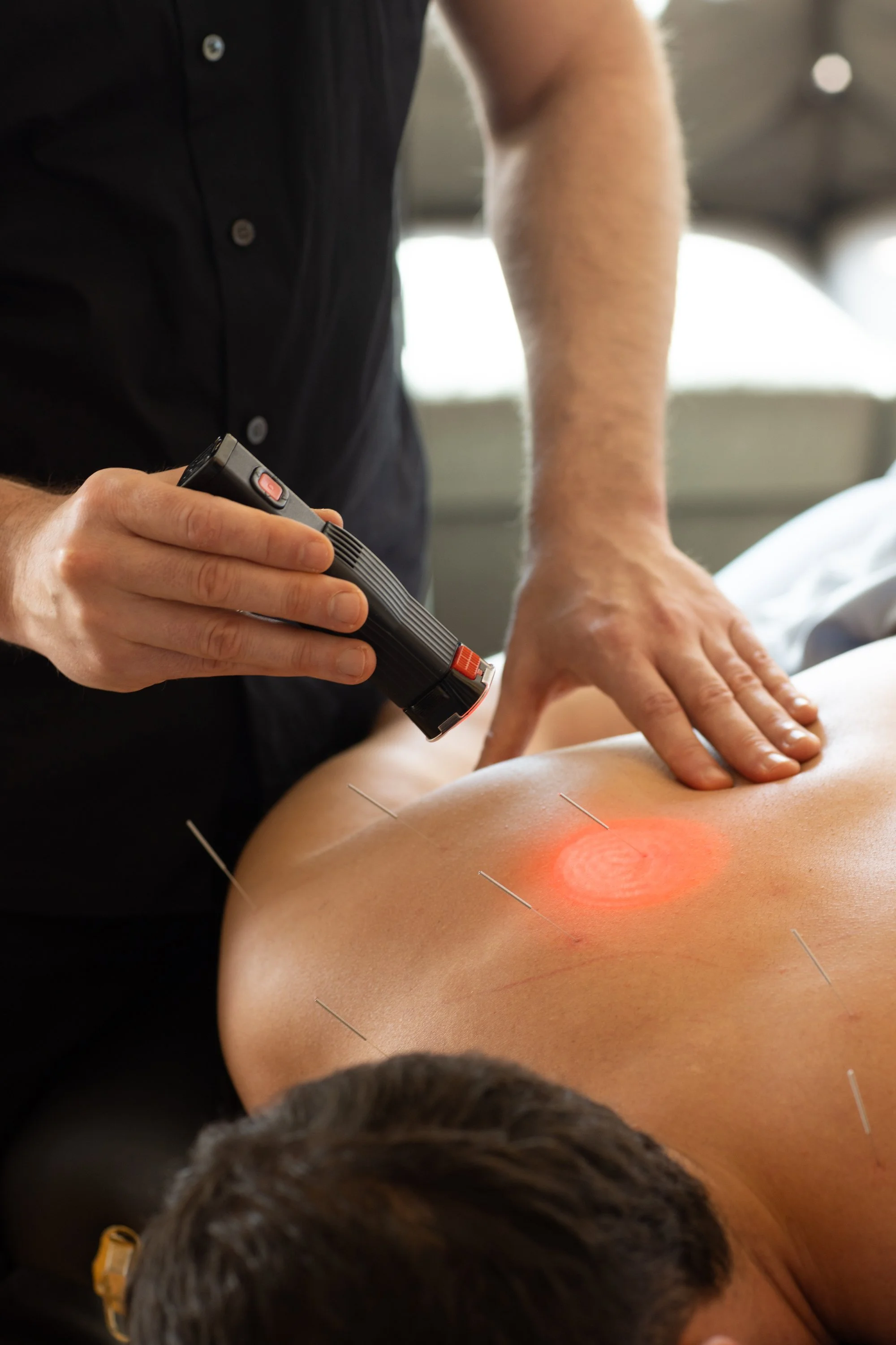 A person receiving a cupping therapy treatment on their back, with several small acupuncture needles inserted around the area. A practitioner is using a laser device on the treatment site.
