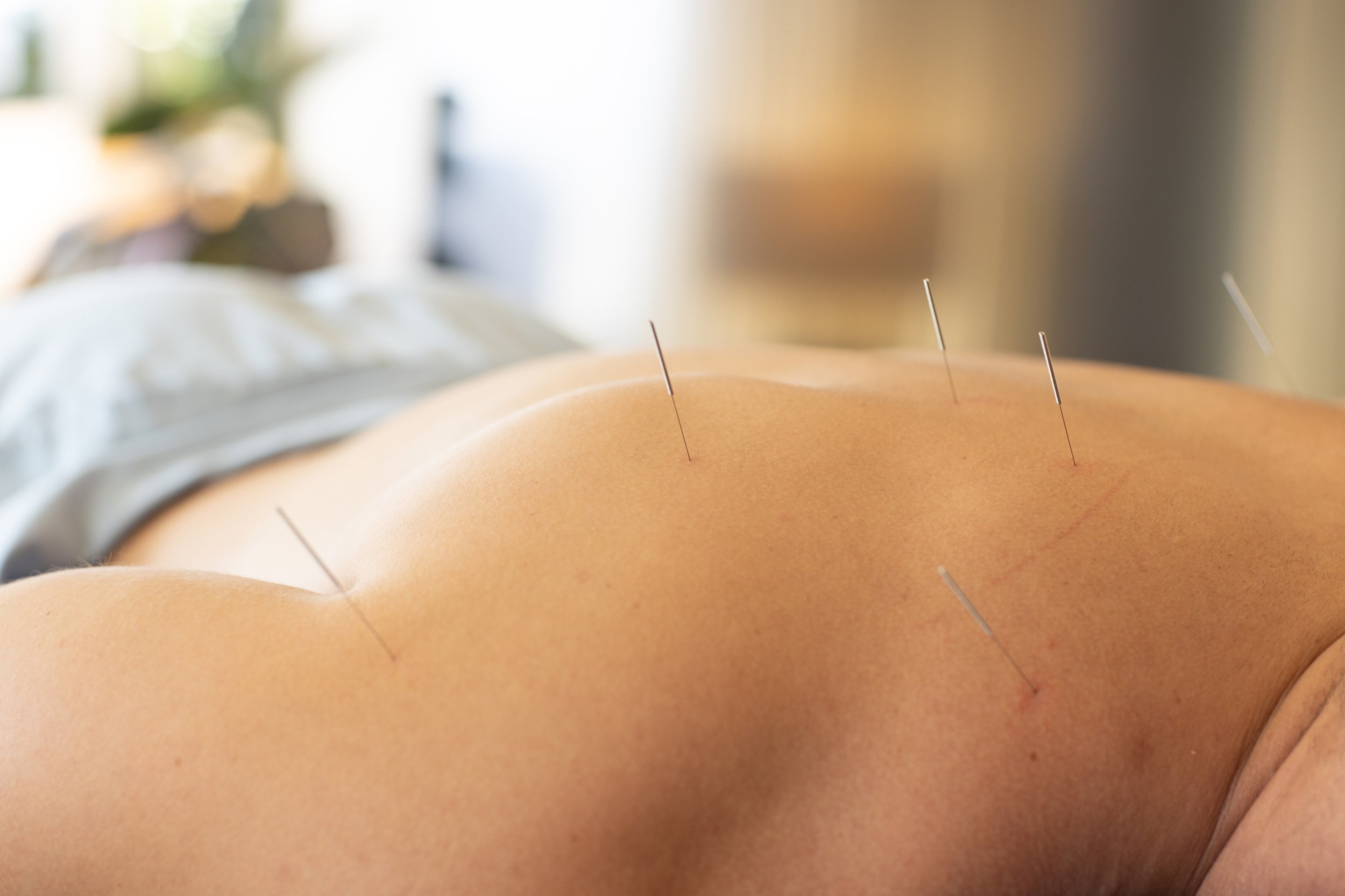 Close-up of person's back receiving acupuncture treatment with several acupuncture needles inserted.