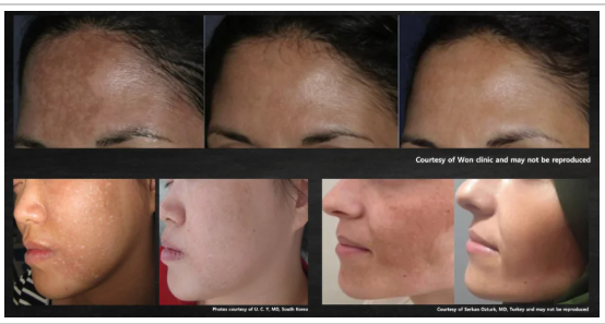 nouvaderm before and after new westminster