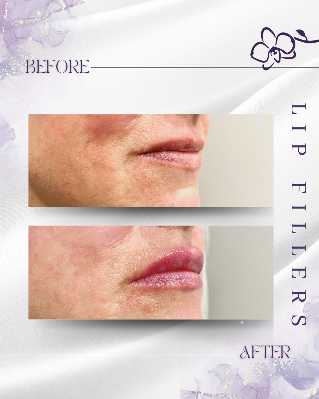 ✨ Holiday glow starts with perfect lips ✨
Soft volume, beautiful shape, and natural results designed to elevate your smile for every celebration, photo, and toast this season 🎄💋💜

Give yourself the gift of confidence this holiday season.

Orchid M