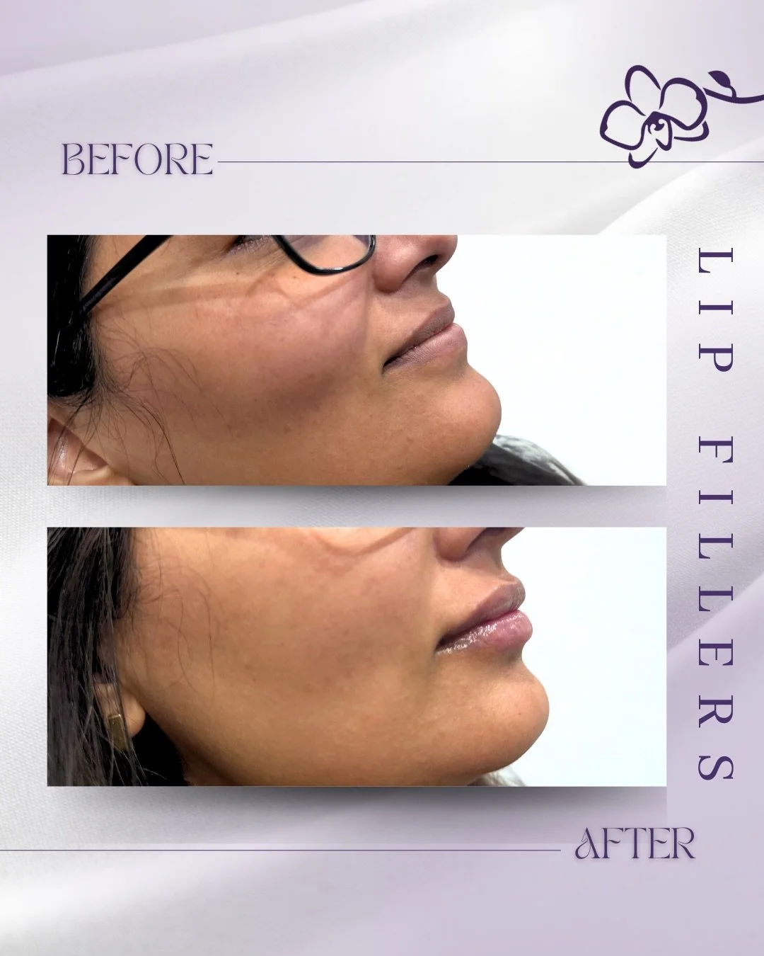 ✨ Natural. Balanced. You, just enhanced. ✨

Lip fillers don&rsquo;t have to look overdone 💋 When done correctly, they restore volume, enhance shape, and keep your lips soft, natural, and perfectly you.

This before and after shows subtle definition,