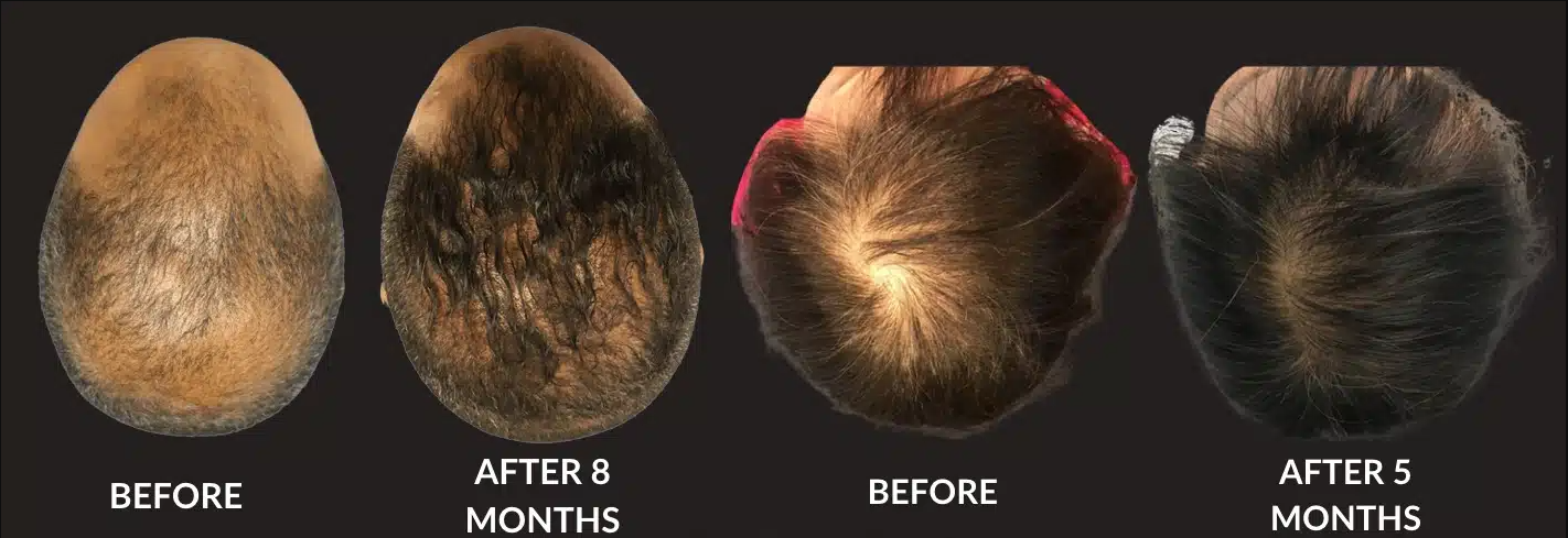 Hair restoration new westminster, de rive + nouvaderm treatment.