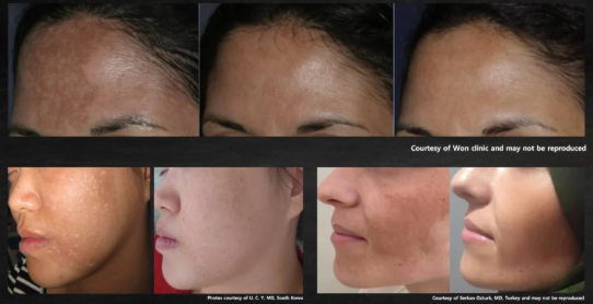 Pigmentation laser new westminster for all skin trypes
