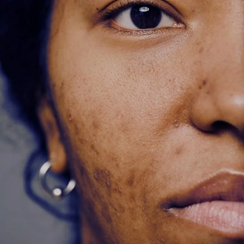 Close-up of a woman's face showing her eye, cheek, and lips, with visible skin texture and some skin blemishes.
