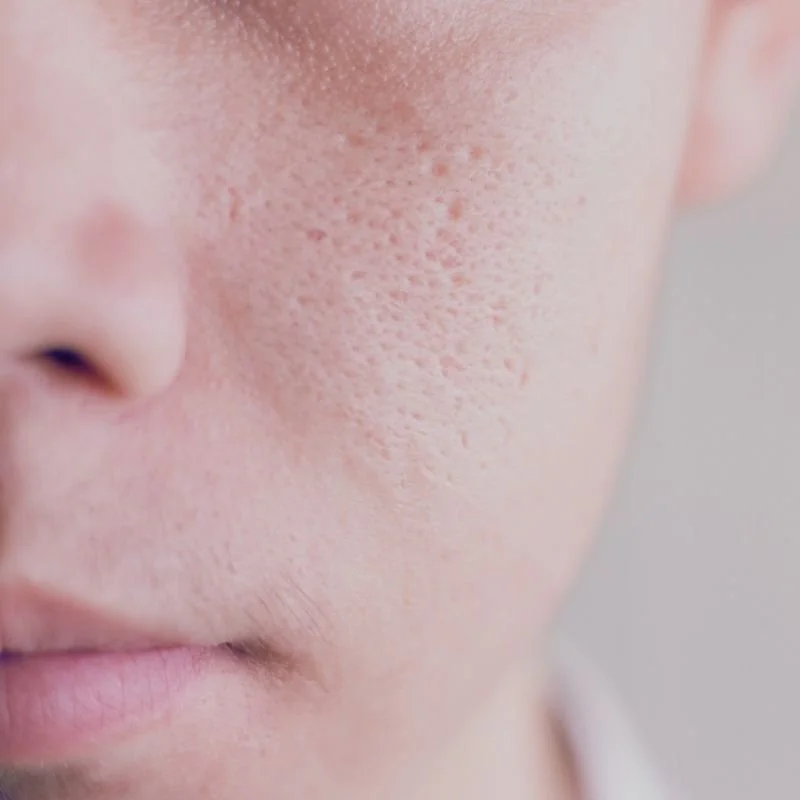 Close-up of a person's cheek showing enlarged pores and rough skin texture.