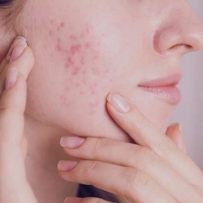 Close-up of a person's face showing red acne scars on their cheek, with fingers touching the skin.